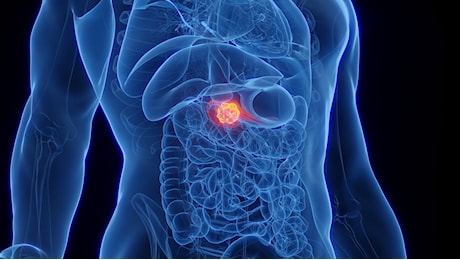 Tumore al pancreas, Jessica chiede aiuto per curarsi e stare con i figli
