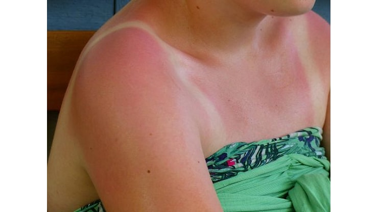 Melanoma, studio Iqvia: meno di un italiano su 4 controlla i nei - Askanews