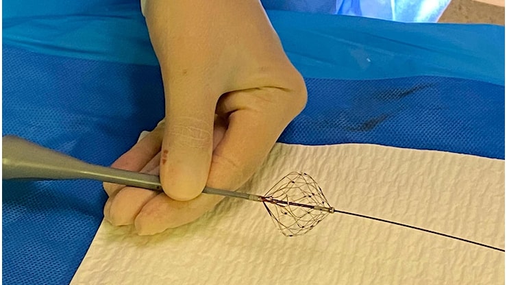 Fibrillazione atriale, per la prima volta in Italia la procedura con catetere a campo pulsato - la Repubblica